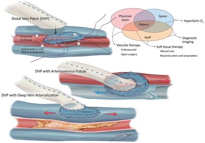 Management of peripheral arterial disease in the context of a multidisciplinary limb program